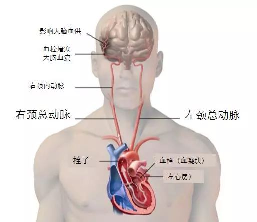 心脏左心耳的血栓脱落导致脑栓塞图.jpg