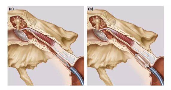 图2（咽鼓管球囊扩张咽鼓管咽部软骨段）.jpg