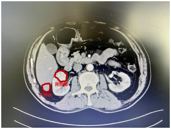 （图中红色沟边物为肝肾肿瘤）.jpg